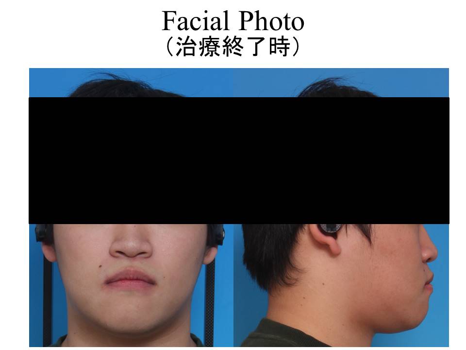 【実際の治療例】下あごの出ているのが気になる顎変形症患者～外科矯正での劇的な変化～ | 矯正歯科Y’s溝の口